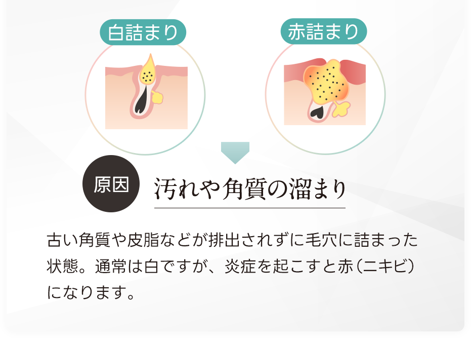 原因：汚れや角質の溜まり。古い角質や菱などが排出されずに毛穴に詰まった状態。通常は白ですが、炎症を起こすと赤（ニキビ）になります。