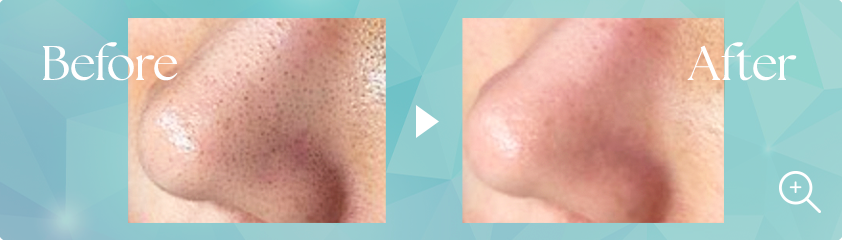 鼻の毛穴Before→After